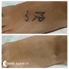 Business 5 image THINK AGAIN LASER CLINIC – AUCKLAND Tattoo Removal in Auckland City AUK